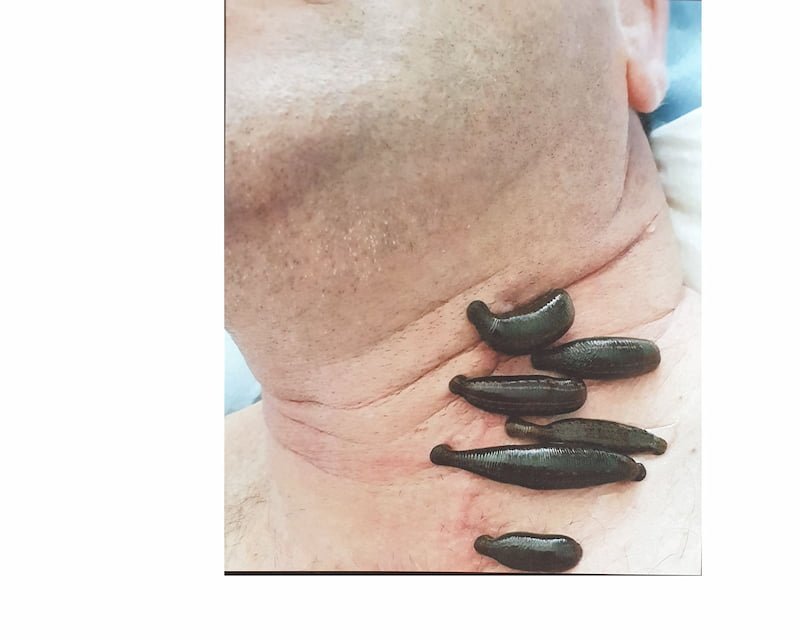 Hirudothérapie cervicale — fibrose cicatricielle post-chirurgicale