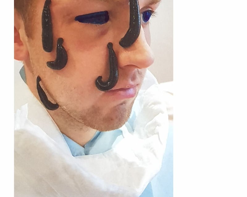 Hirudothérapie fracture orbite — sangsues sur le visage