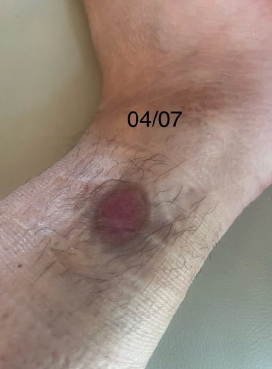 Plaie cheville après chromatothérapie — 04 juillet 2026