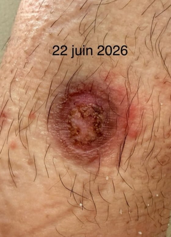 Plaie cheville avant chromatothérapie — 22 juin 2026