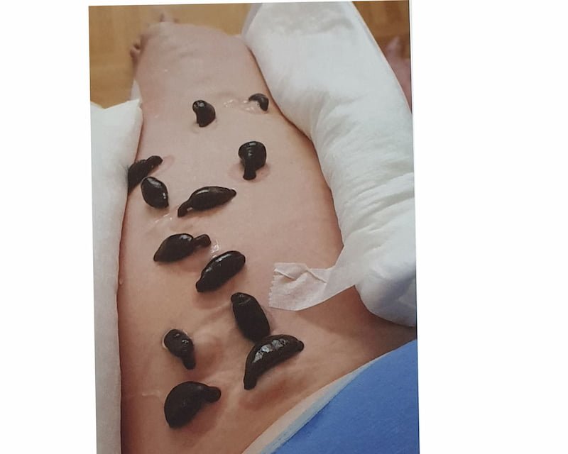 Sangsues sur varices — séance 1
