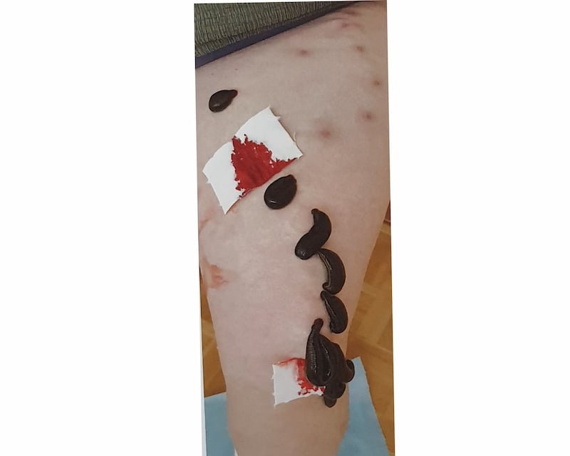 Sangsues sur varices — séance 2