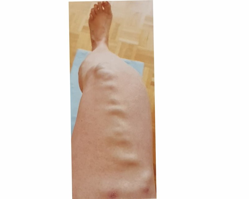 Varices avant traitement